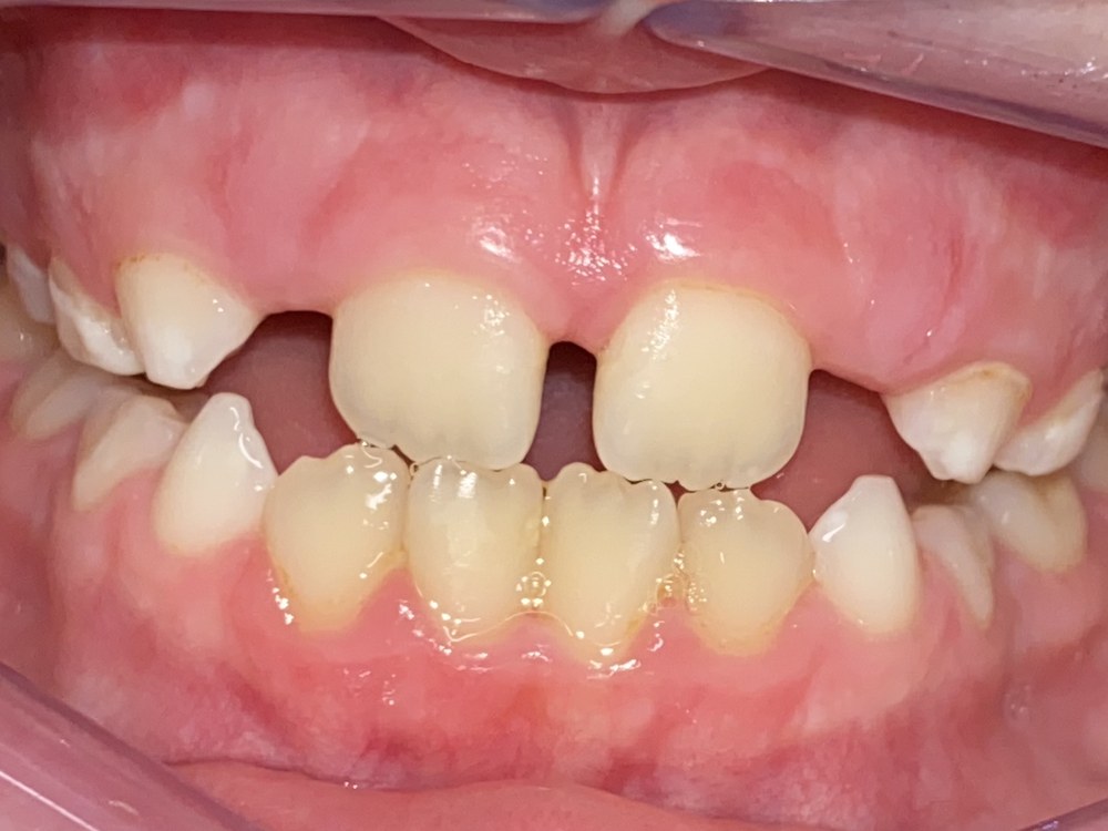 Caso de ortopedia de clase III, antes del tratamiento: mordida cruzada anterior en dentición mixta