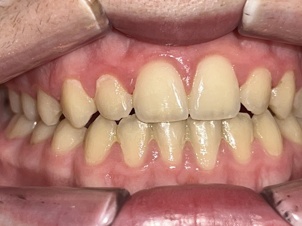 Caso de ortopedia de clase III, después del tratamiento: dentición permanente alineada